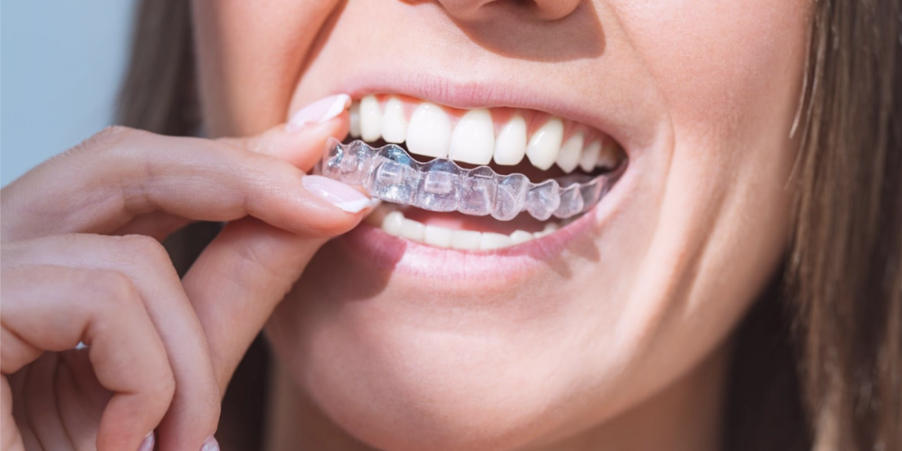 Invisalign Braces: A Clear Path to a Straighter Smile